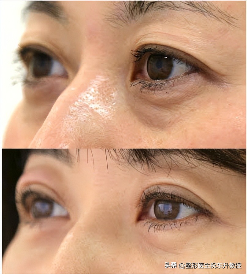 手术祛眼袋会有什么后遗症,超声波祛眼袋有什么后遗症