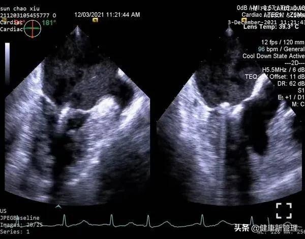 二尖瓣微创钳夹术全过程怎么做,二尖瓣微创钳夹术视频