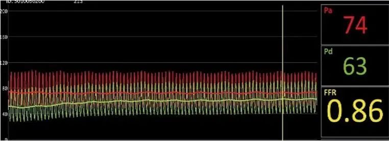 首创国内ICAS多模态评估体系开创脑血管领域精准诊疗新纪元