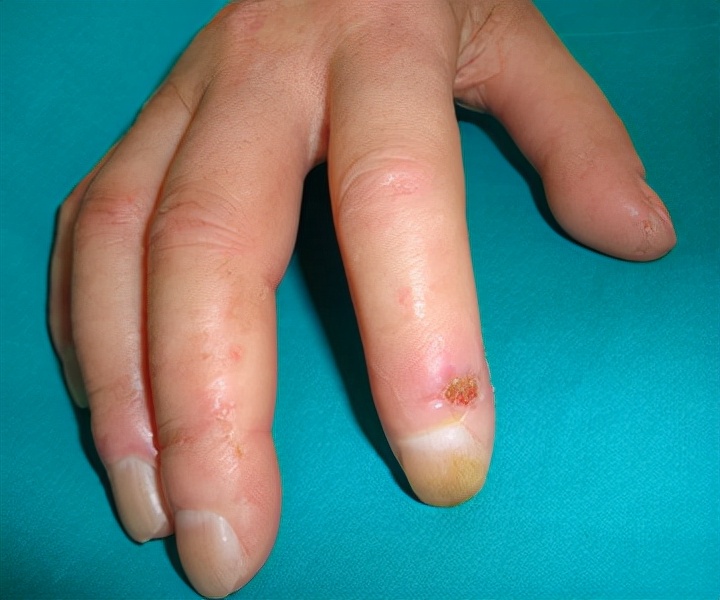 伟哥可以治疗的疾病,伟哥原来是用来治疗什么疾病