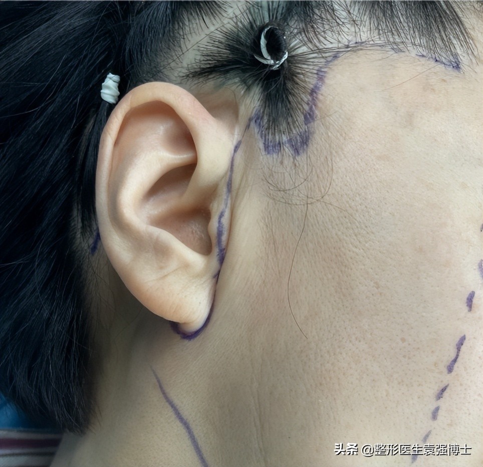 拉皮手术是额头切口还是耳前切口,拉皮手术耳前切