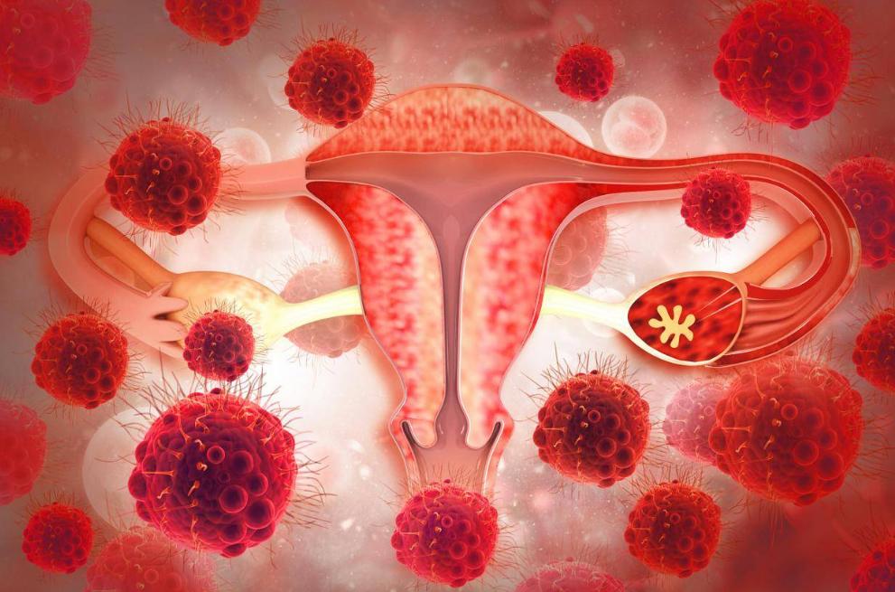 48岁女子确诊宫颈癌，子宫全切，身体这4处异常变化，别再忽视！