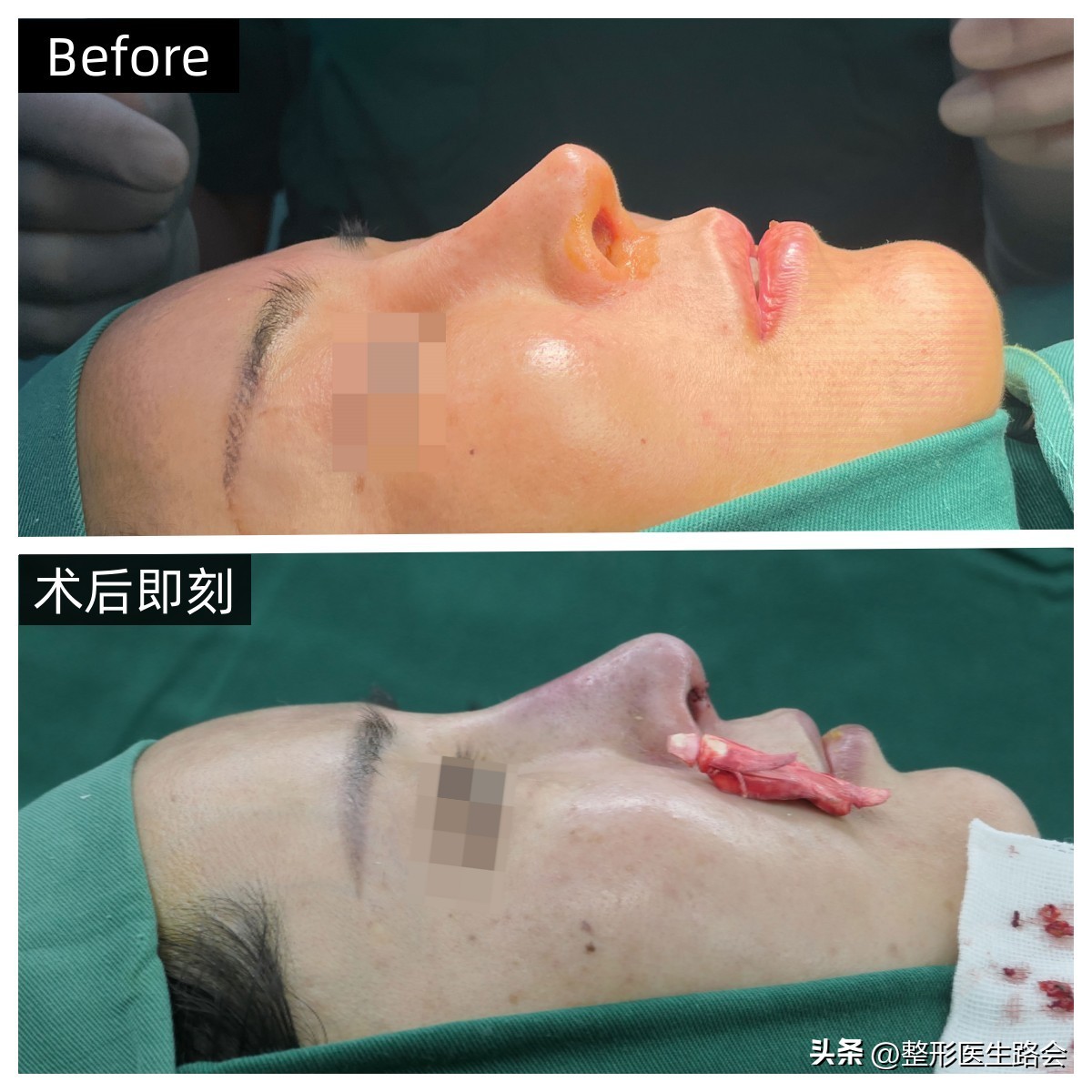 隆鼻到底要不要只做鼻头,隆鼻前要检查哪些项目