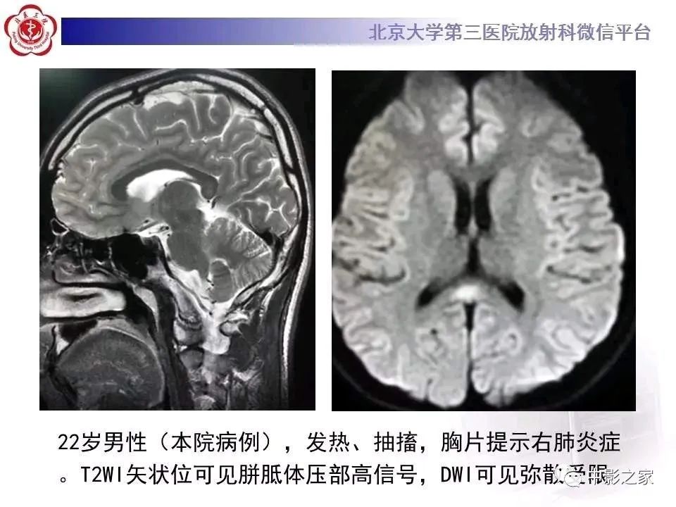 什么叫原发性胼胝体变性,原发性胼胝体变性治疗多少钱