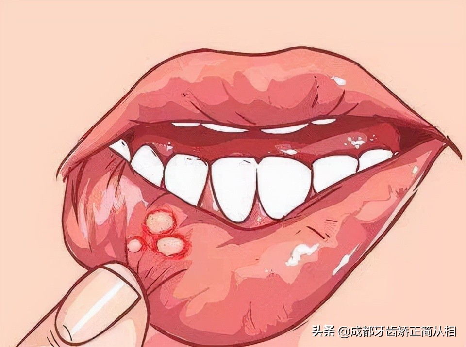 戴牙套多久不会磨嘴长溃疡,矫正牙套磨破嘴怎么办