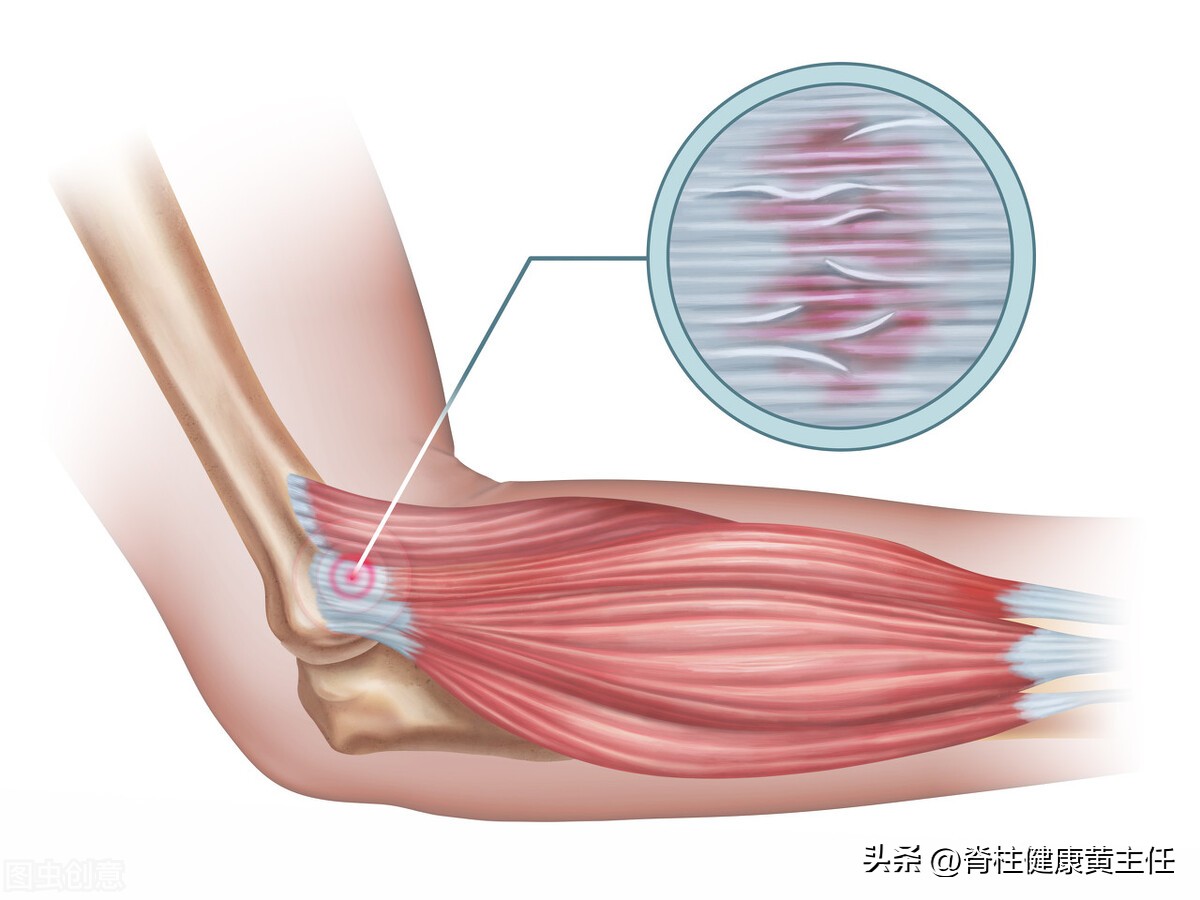 高尔夫球肘康复,什么是高尔夫球肘该如何治疗