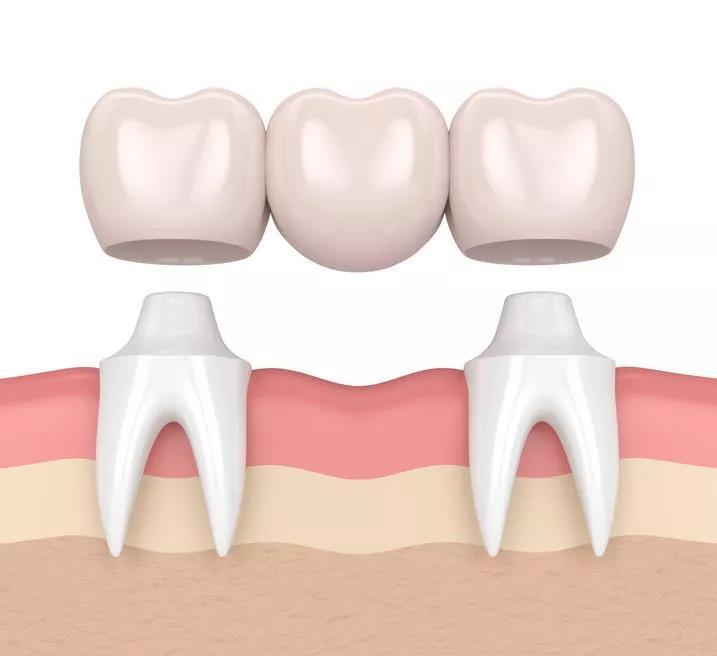 植得口腔矫正不满意可以改方案吗,植得口腔树脂修复门牙
