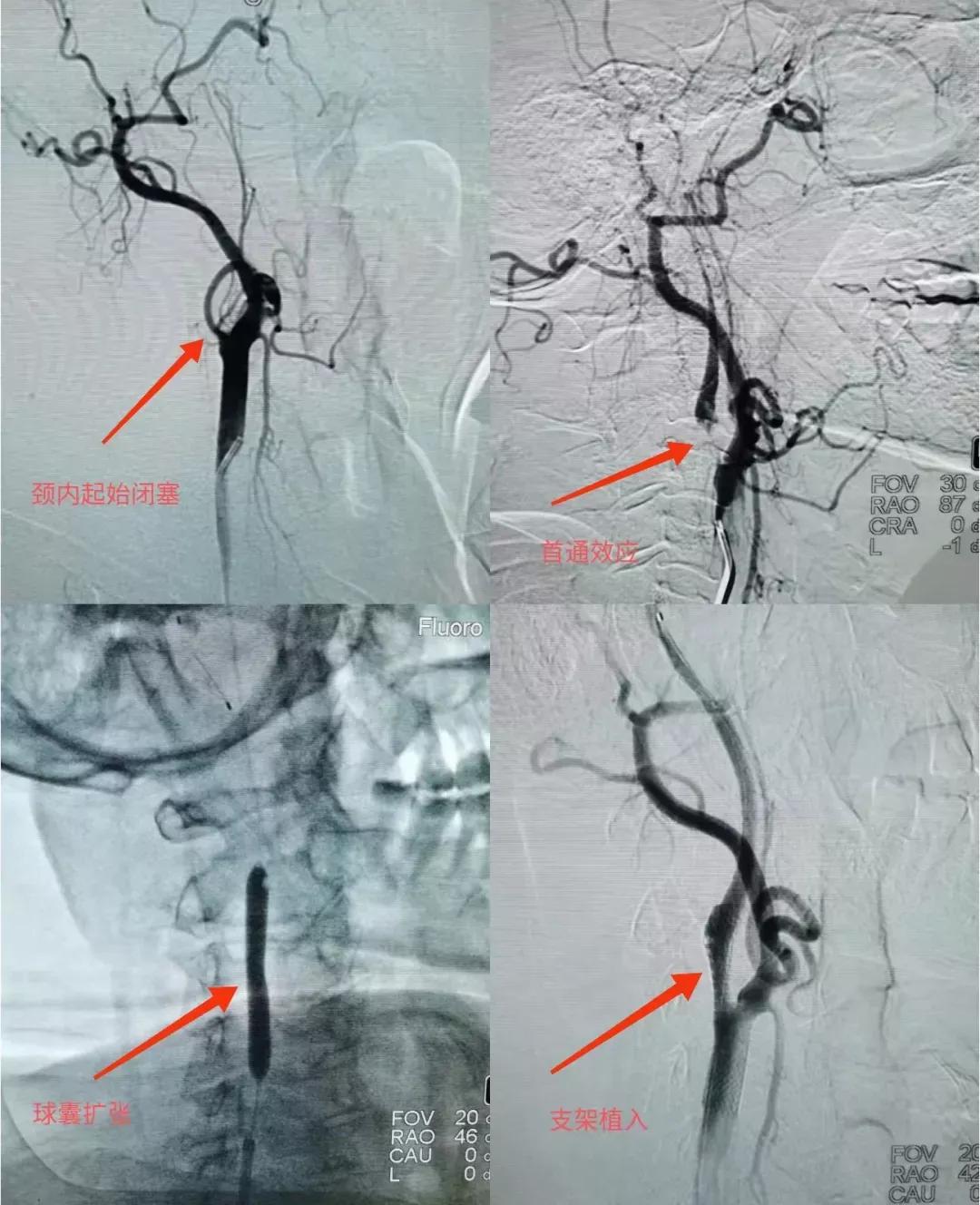 溶栓取栓争分夺秒,争分夺秒抢救脑梗