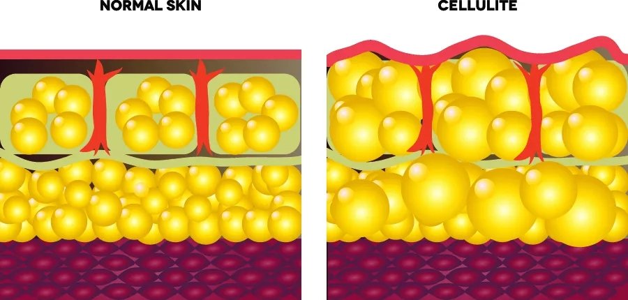 大腿上坑坑洼洼怎么办,大腿上坑坑洼洼的是什么原因
