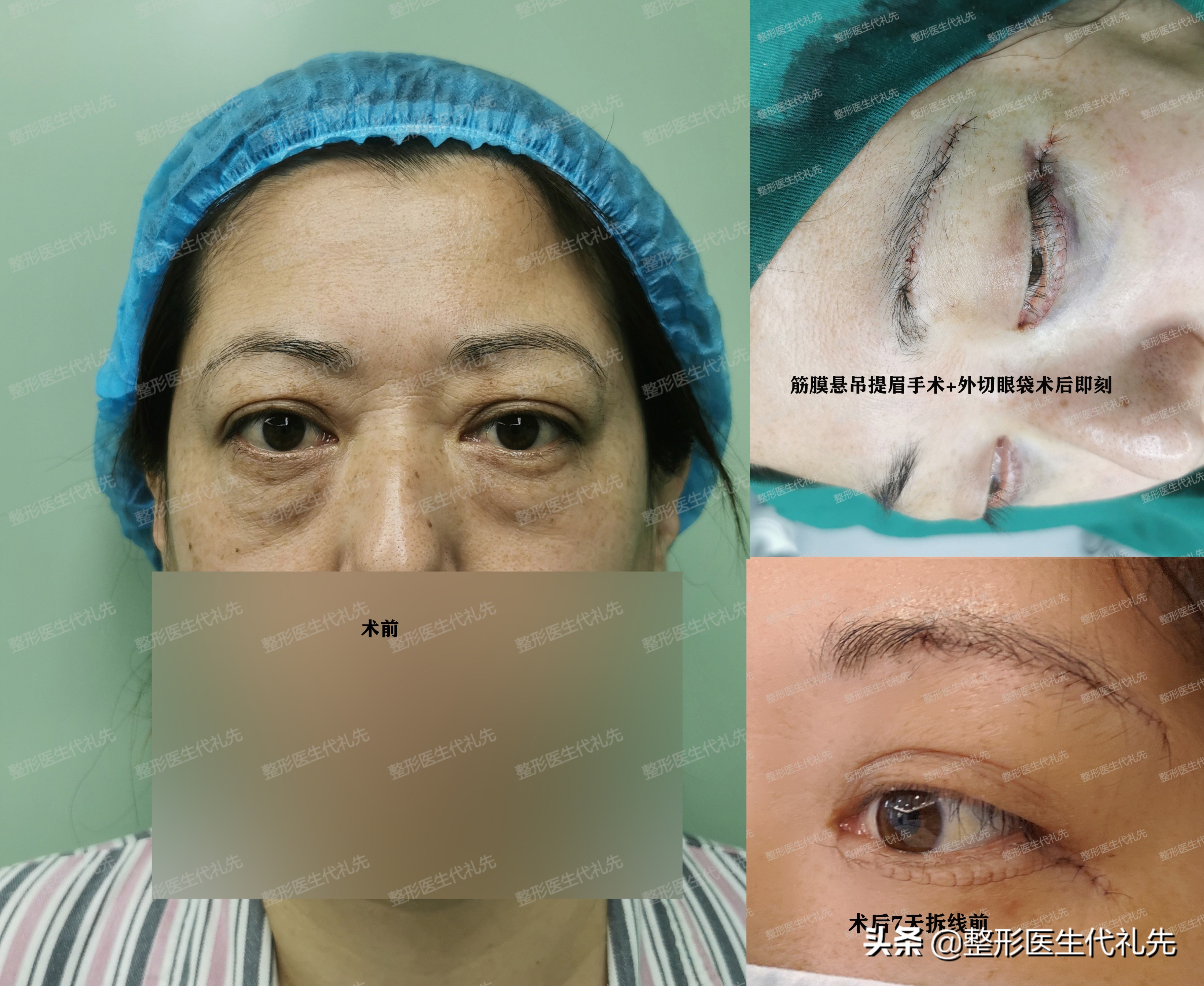 做眼袋的内切和外切的利弊,外切眼袋与内切眼袋的鉴定