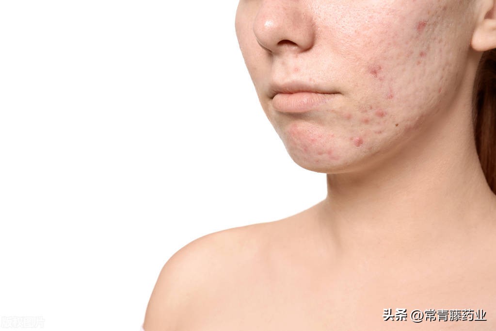 痘坑如何祛最好,痘坑怎么祛