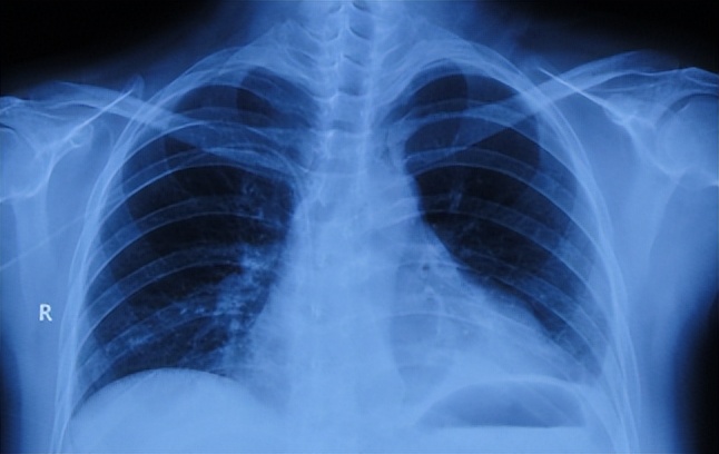 听神经瘤出现脑积水和出血,听神经瘤手术后颅压高症状