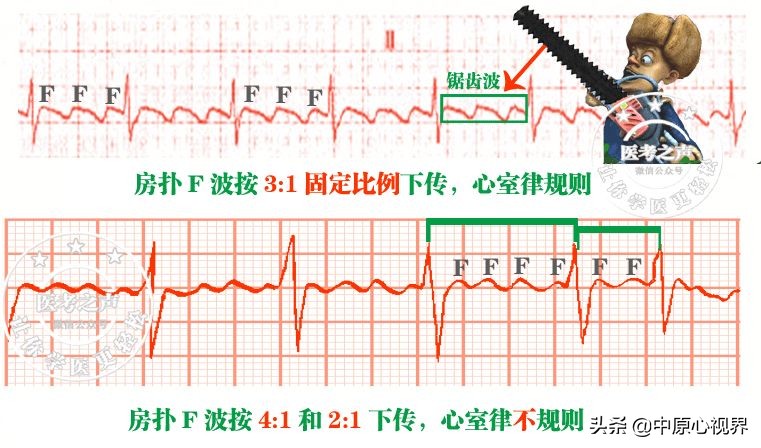 护考几种常见的心电图,常见的心电图图形分析