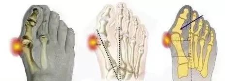大脚趾外翻怎么治最好,大脚骨外翻走路疼痛怎么办