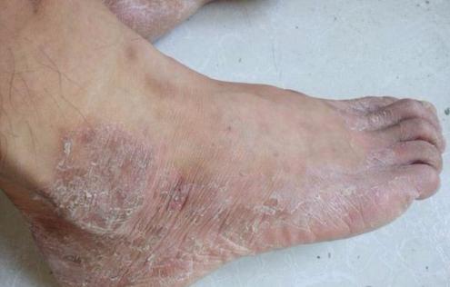 日本人如何处理脚气问题,欧美人为什么更容易患脚气