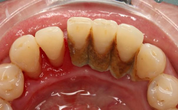 过年牙疼怎么办医生都不上班,老牙疼怎么办最有效方法