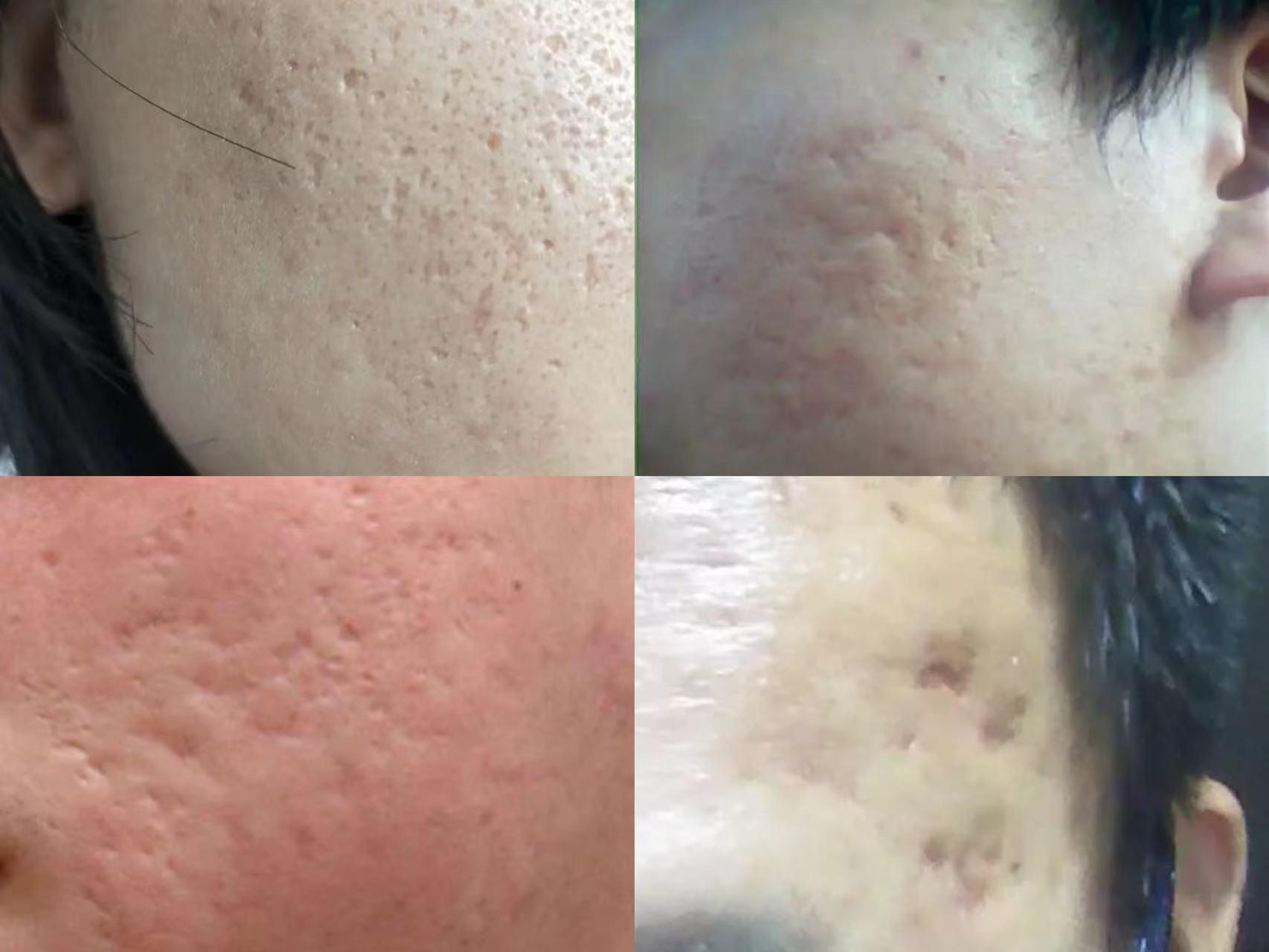 痘坑目前最好的处理方法,痘坑咋办呀