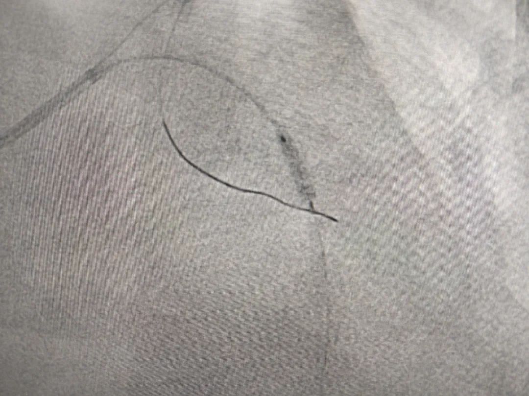 血管衰老的克星,血管钙化能做支架吗