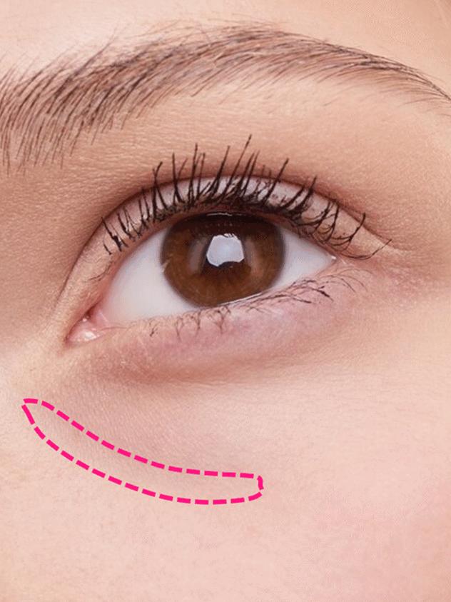 泪沟怎么消除,有泪沟怎么办