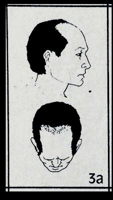 秃头康复,秃头可通过头疗生发吗