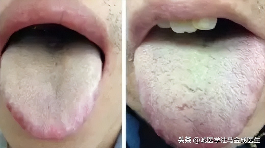 胃火旺会容易饿是实火还是虚火,脾胃湿热去胃火吃什么中成药