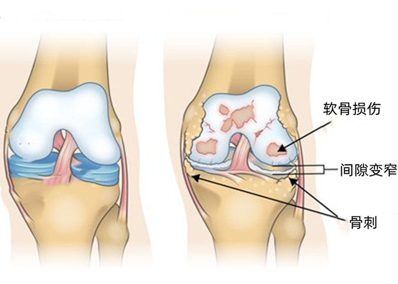 中年人膝盖退化怎么办,多大岁数膝盖开始退化