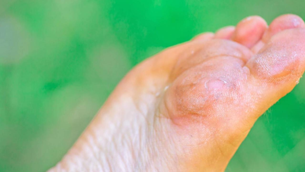 脚底板爱紫是什么原因,脚底板爱起皮是怎么回事