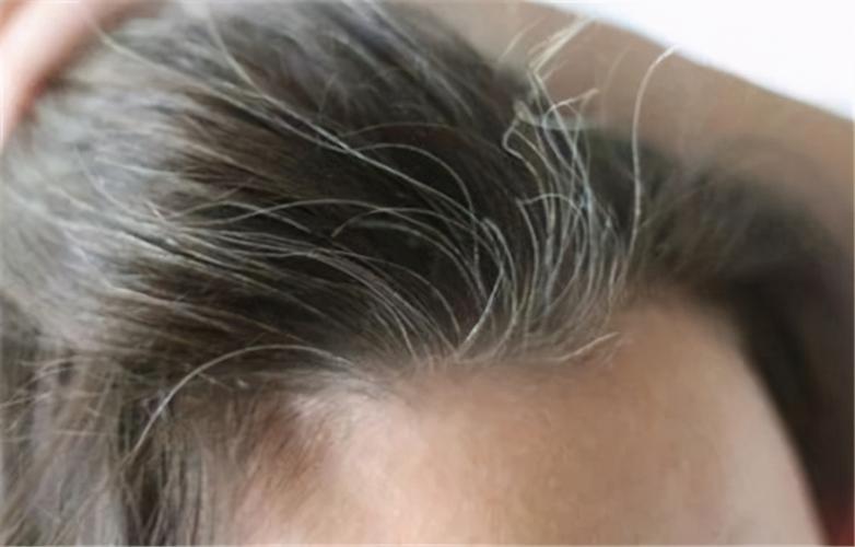 白头发拔一根长10根是不是真的,白发真的会拔一根长10根吗