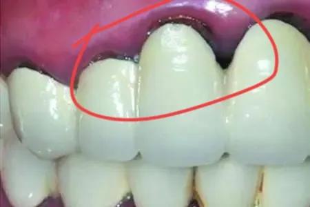 范冰冰做烤瓷牙前后照,范冰冰做的牙贴片还是烤瓷牙