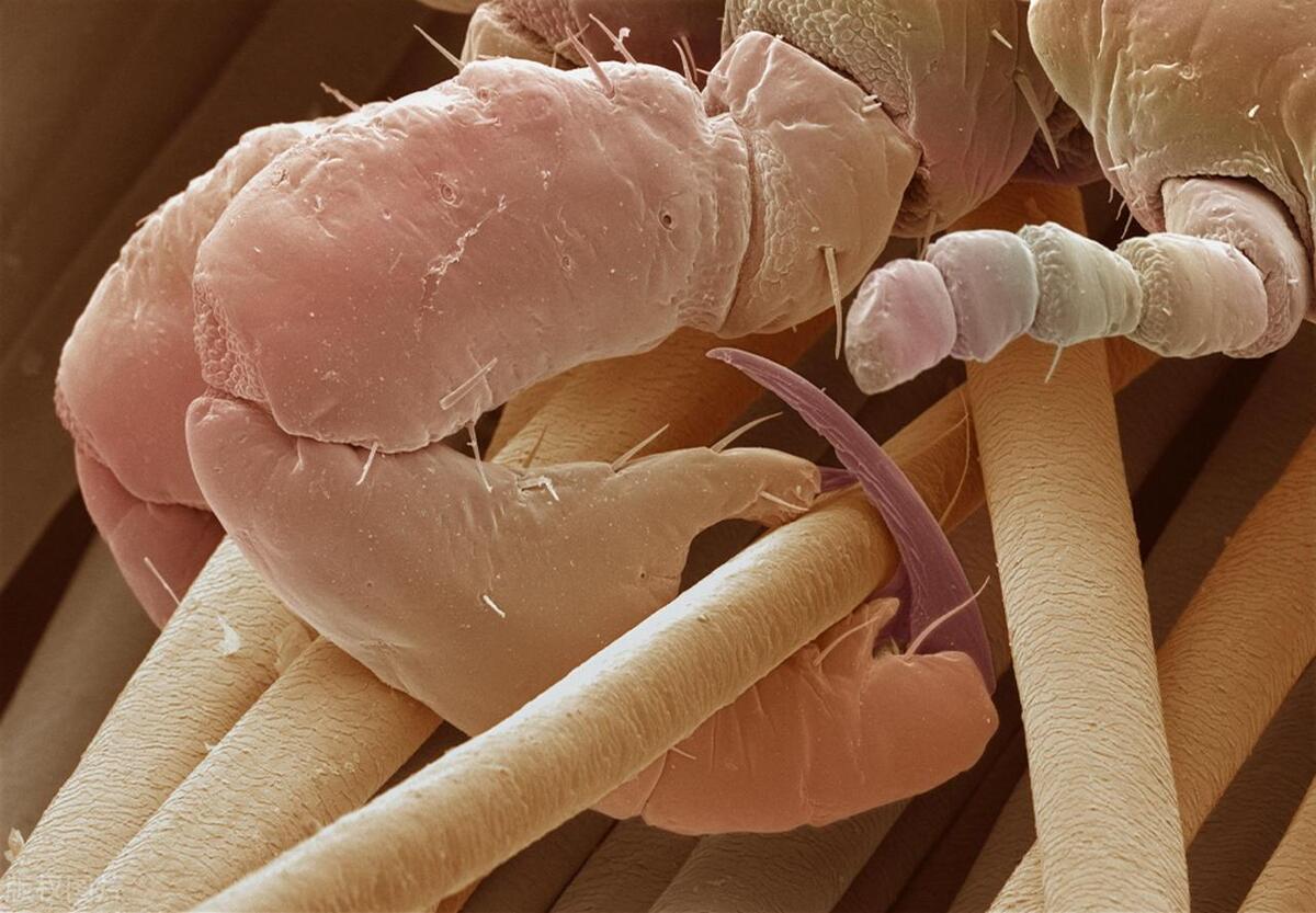 与大我20岁成熟男人面基，第二天*处私**瘙痒难耐，去医院夹出阴虱