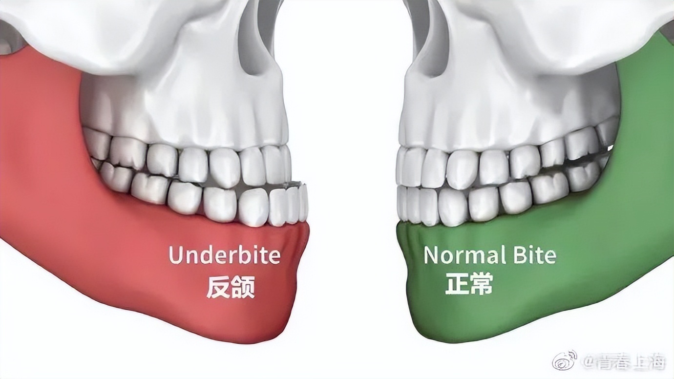 妈妈发视频被网友提醒反颌,家长担心孩子反颌如何回复