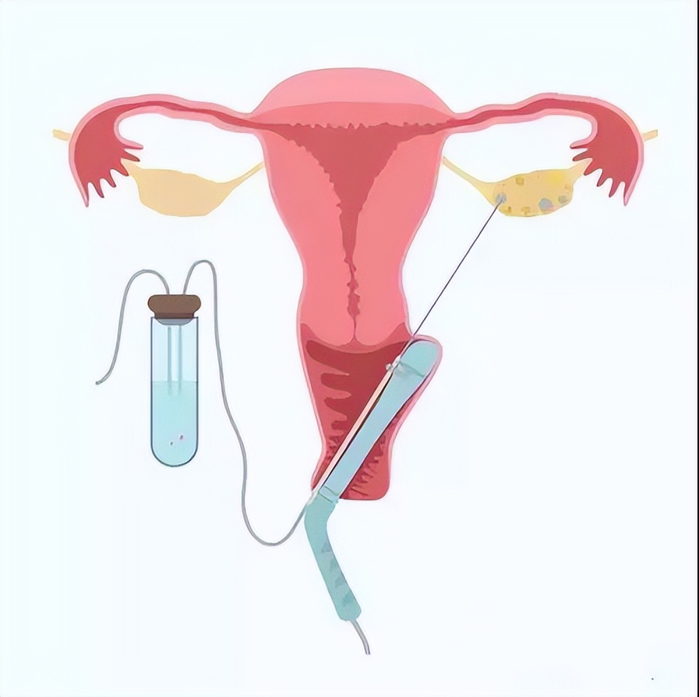 做完试管婴儿取卵后,如何让卵巢更快的恢复?