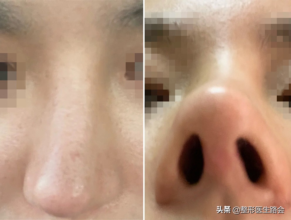 为什么隆鼻很久了鼻子还会歪,隆鼻了怎么确定鼻型歪不歪
