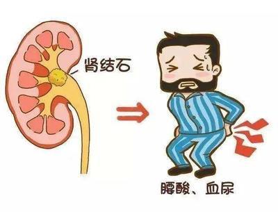 别让万物复苏的时节，成为尿路结石的“春天”！