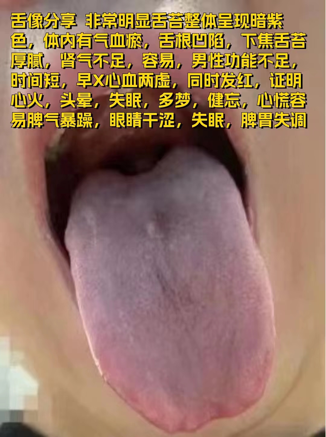 今日舌诊,舌尖舌根凹陷中医辨证