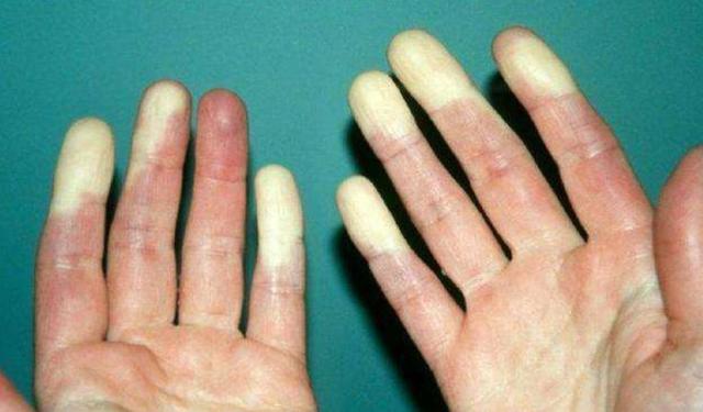 血压高不高看腿脚就知道,血压高的人多观察手指