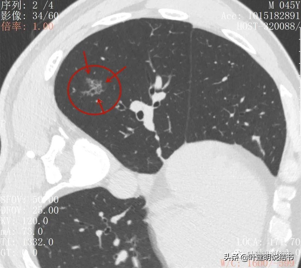 误诊肺纤维化,肺蜂窝状是癌吗