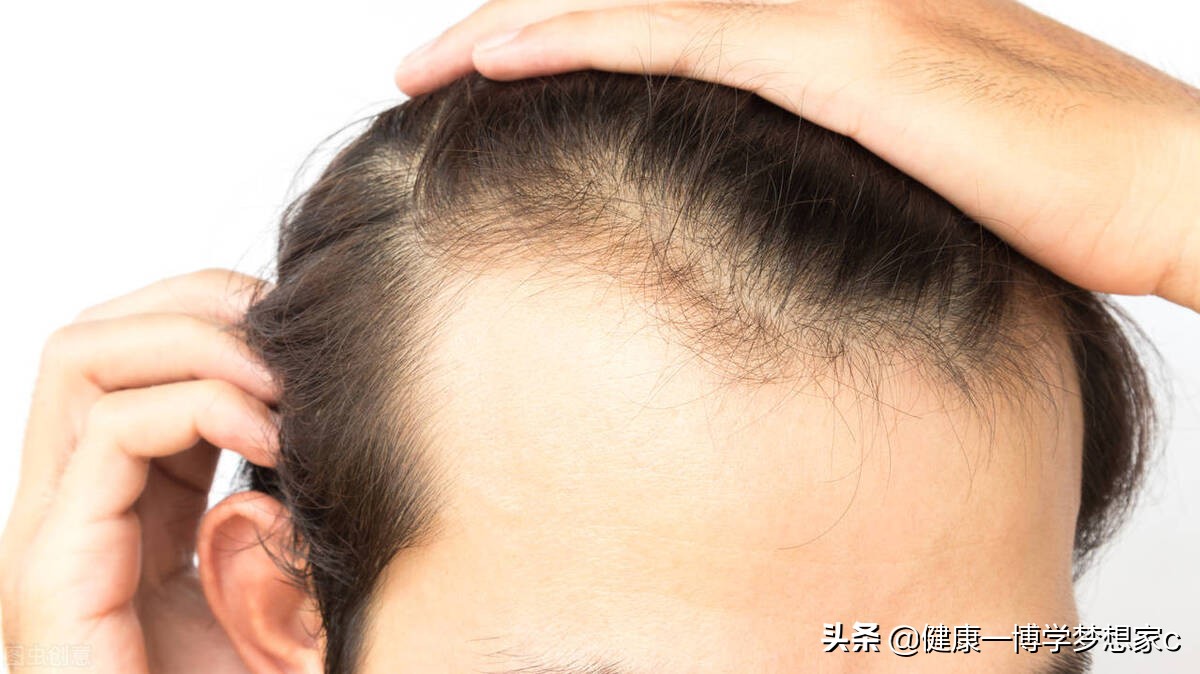 用了6个月米诺地尔,用了6个月的米诺地尔酊