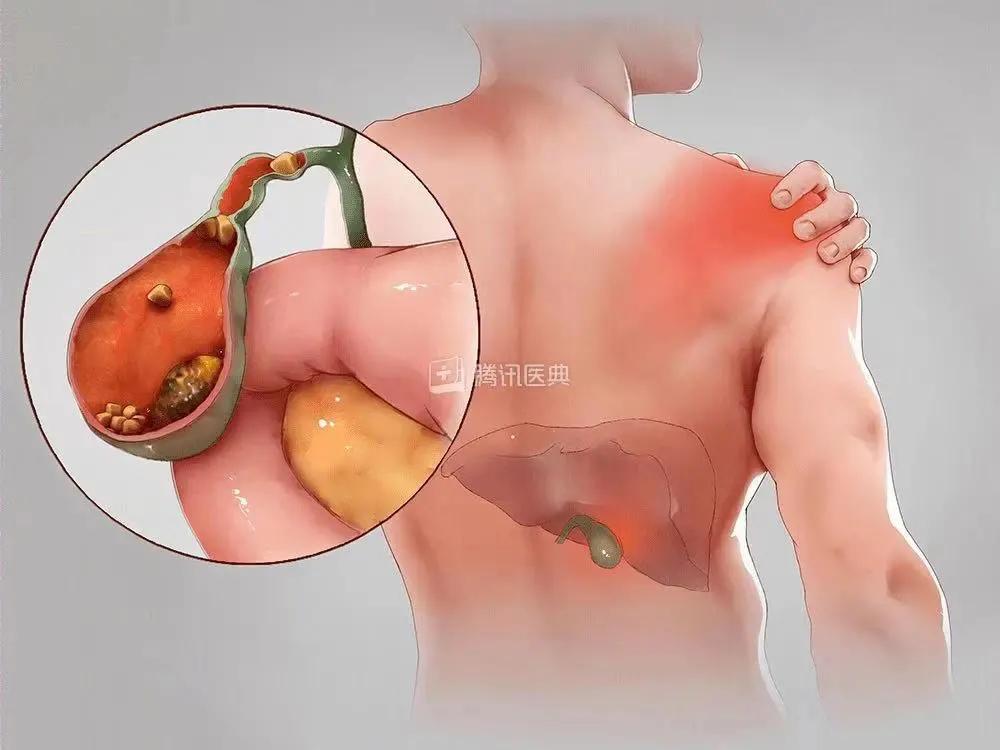 胆管结石多喝水有用吗,胆管结石多喝水有效吗