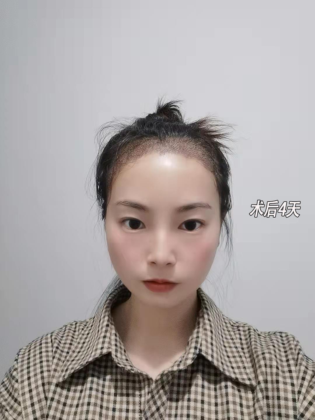 恒美植发需要多少钱,恒美植发跟碧莲盛植发