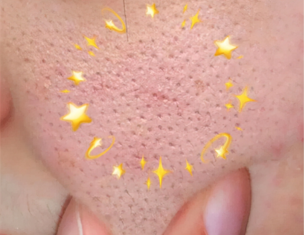 遗传性毛孔粗大,毛孔粗大形成的因素