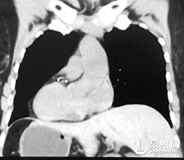 罕见镜面人手术反着来,医生手术切除罕见肿瘤