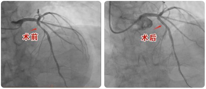 横州人民医院介入治疗冠心病,血管内超声检查冠心病的精准度