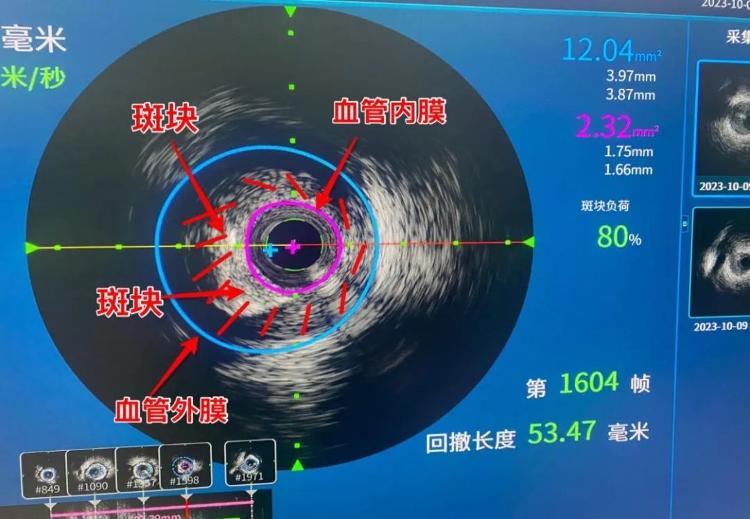 横州人民医院介入治疗冠心病,血管内超声检查冠心病的精准度