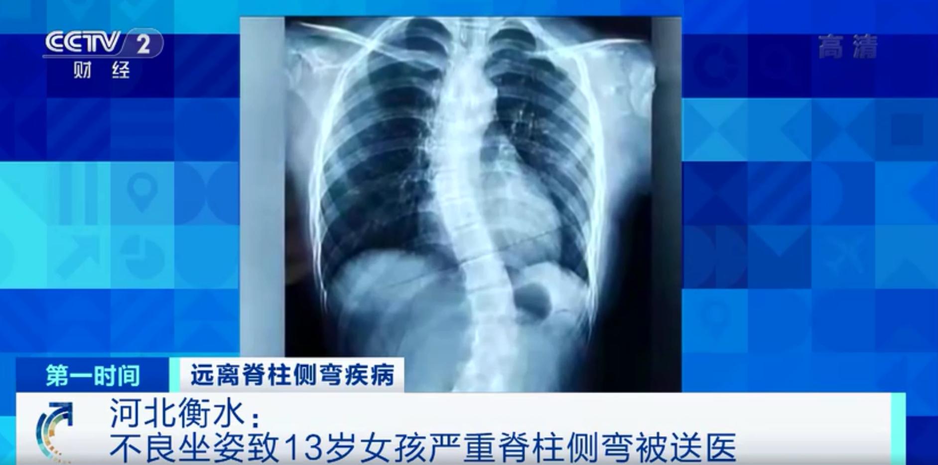 警惕青少年脊柱侧弯早预防早治疗,怎么防止十几岁的孩子脊柱侧弯