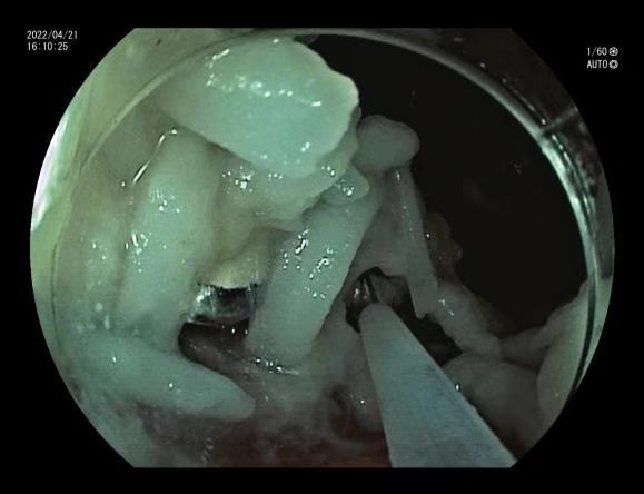 误吞假牙一颗,误吞很小的假牙