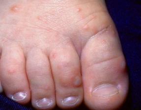 儿童生疹子哪里红点多,怎么区分孩子起的各种疹子