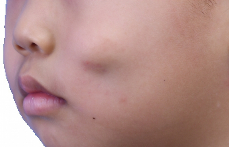 脸部受伤留疤怎么索赔,伤口留疤可以要求对方赔钱除疤吗