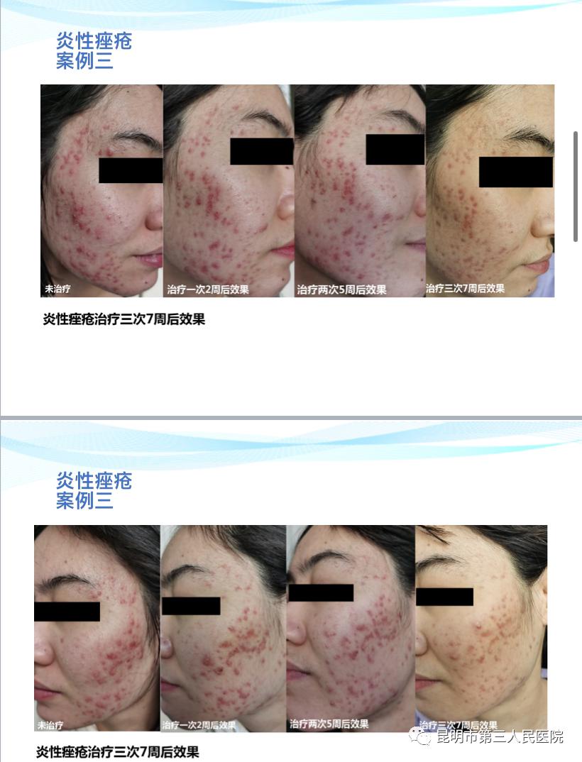 超甜礼遇“6·18”！昆明市三院皮肤科化学换肤术活动来袭