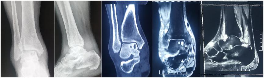 扭伤脚踝五十多天了走路就肿,踝关节扭伤半年后突然疼痛